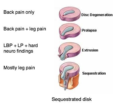 Difference between different conditions of disc