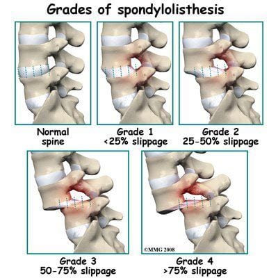 spondylolisthesis 