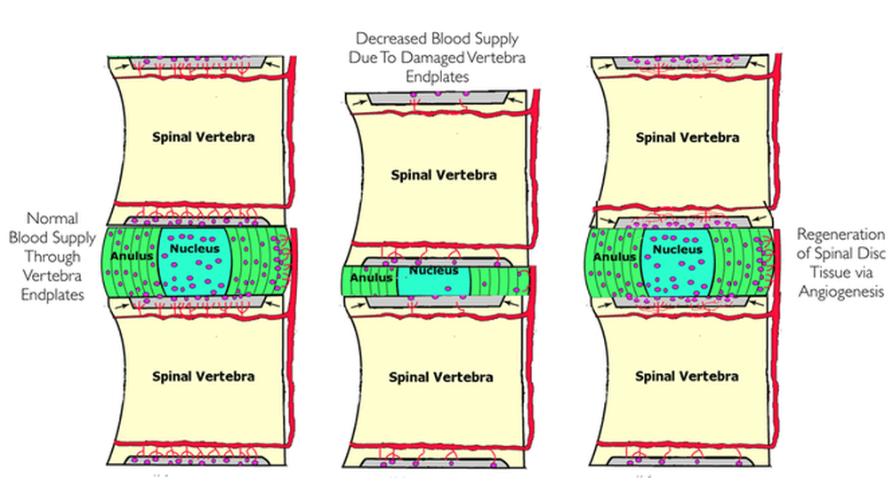 Best Successful Ayurvedic Treatment for Degenerative Disc Disease