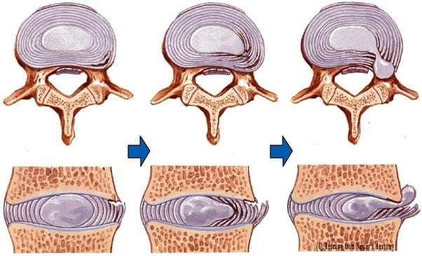 protrusion of a normal disc of spine