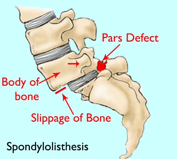 Spondylolisthesis with pars defect