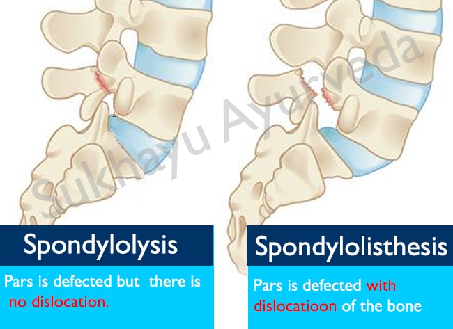 difference between Spondylosis and Spondylolisthesis