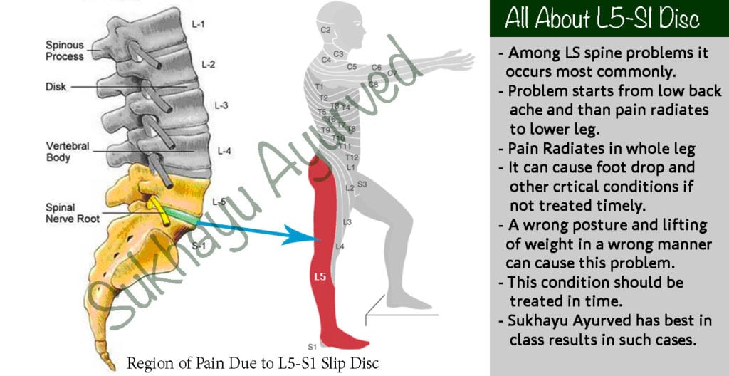 all about Treatment of L5-S1 disc