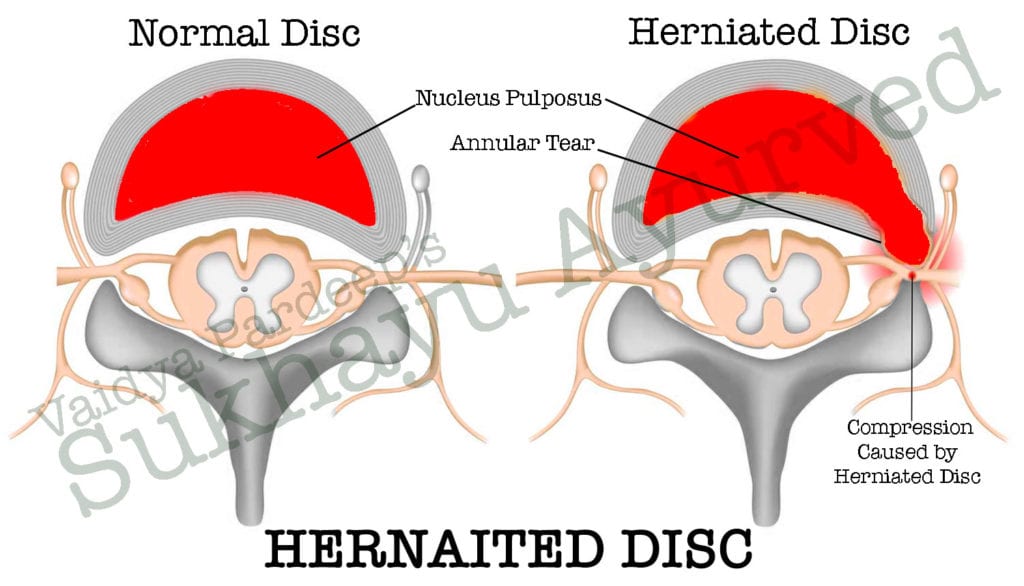 Hernaited Disc