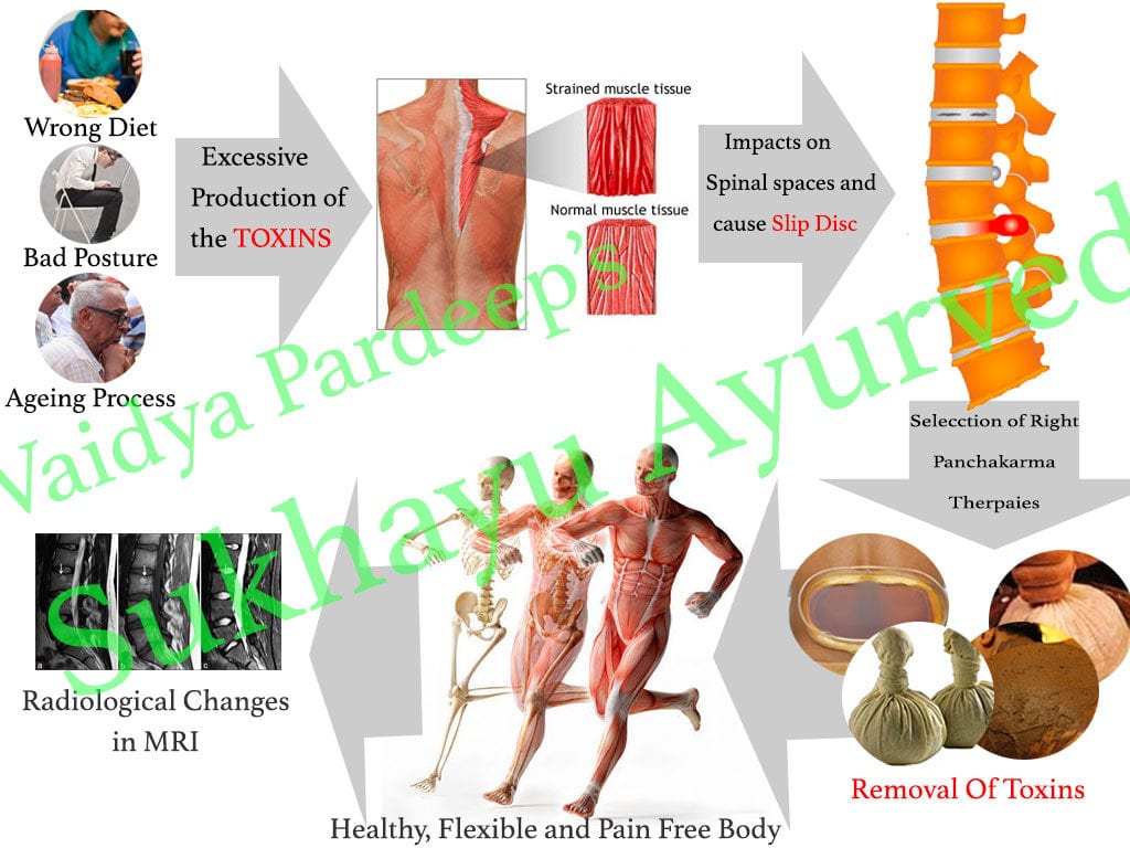 Panchakarma treatment for slip disc 