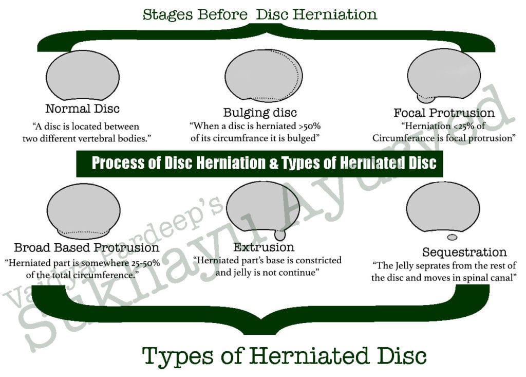 Process of disc herniation and types of herniated disc.