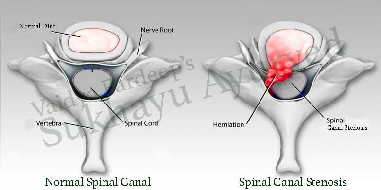 Ayurvedic Treatment for Canal Stenosis