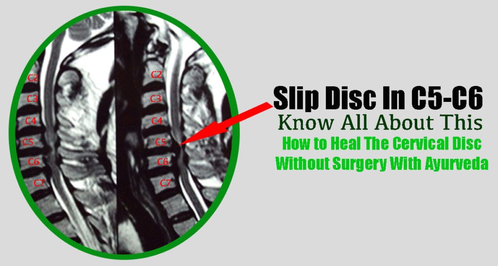 C5-C6 slip disc