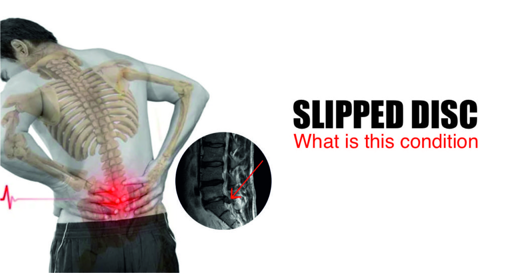 slipped disc